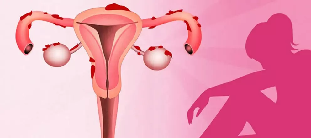 Hoy se conmemora el Día Mundial de la Endometriosis, que afecta a las mujeres