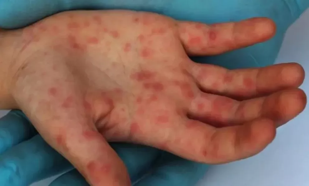 El Ministerio de Salud confirmó un caso de sarampión en el país
