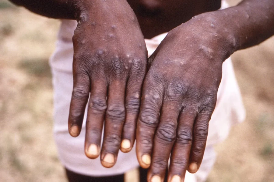 La OMS declara al mpox como nueva emergencia de salud pública internacional