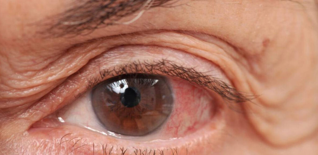 El Ministerio de Salud se adhiere a la Campaña Nacional de Detección de Glaucoma