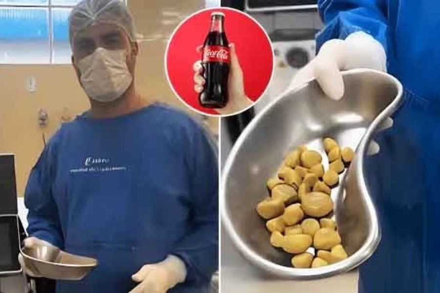Extrajeron 35 piedras de la vejiga tras años de tomar hasta tres litros de Coca al día