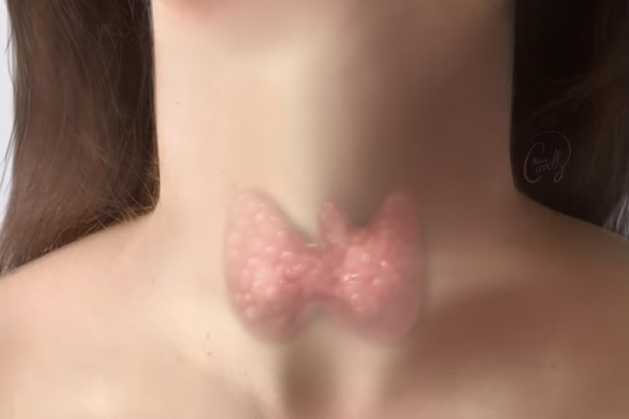 El 97% de los casos de cáncer de tiroides se cura con un diagnóstico a tiempo: Cuáles son los síntomas y cómo se detecta