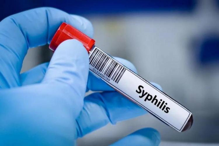 Brote de sífilis en Argentina con cifras récord en jóvenes y adultos