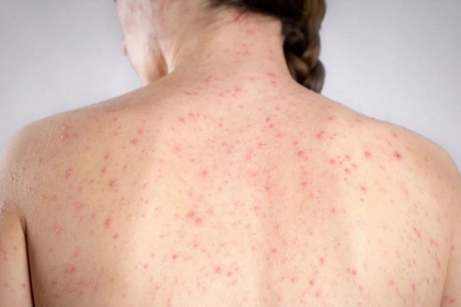 Santiago del Estero refuerza vigilancia sanitaria ante alerta nacional por sarampión Santiago del Estero refuerza vigilancia sanitaria ante alerta nacional por sarampión