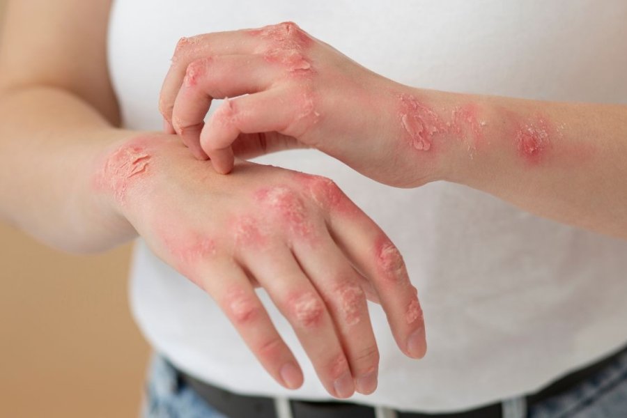 Confirman un caso de sarampión tras un viaje al exterior y refuerzan la vigilancia sanitaria