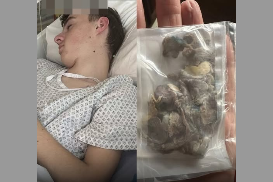 Grave caso por vapeo: Joven fue operado y le mostraron el daño irreversible en sus pulmones