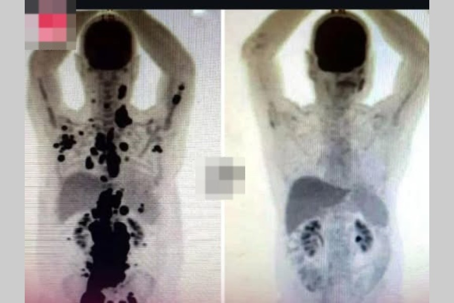 Paciente logra remisión total de cáncer en un mes gracias a una terapia celular innovadora