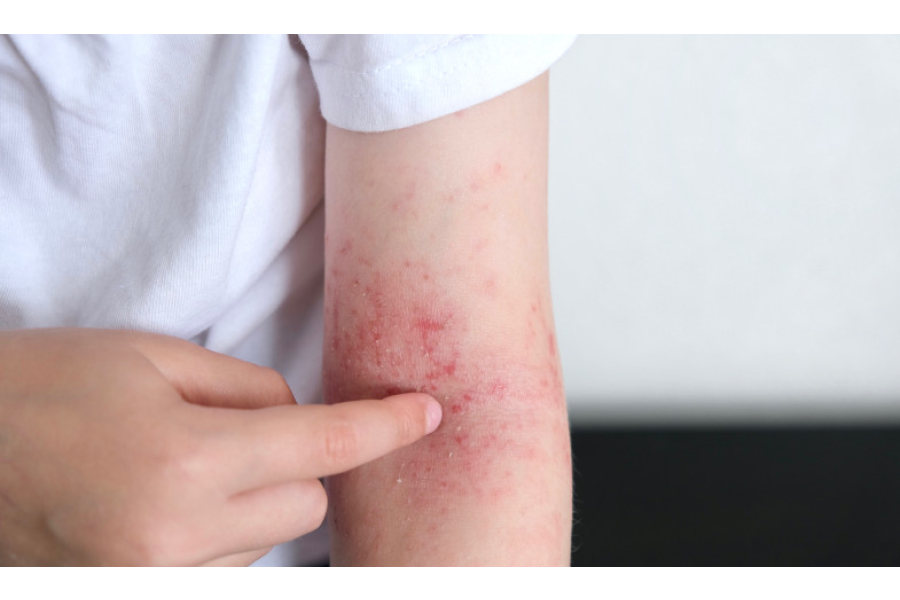 La dermatitis atópica como señal temprana del desarrollo de futuras enfermedades alérgicas La dermatitis atópica como señal temprana del desarrollo de futuras enfermedades alérgicas