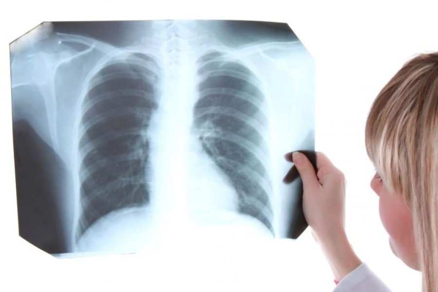 El Ministerio de Salud advirtió un aumento del 71,6% en los casos de tuberculosis en Argentina El Ministerio de Salud advirtió un aumento del 71,6% en los casos de tuberculosis en Argentina